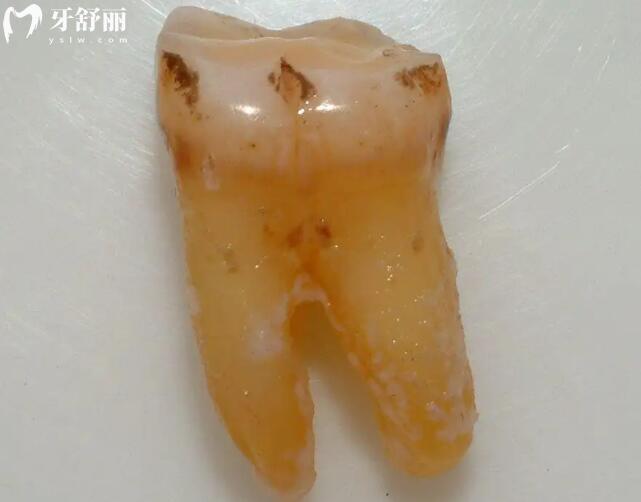 拔牙后多久可以種植牙根和牙冠圖片大全