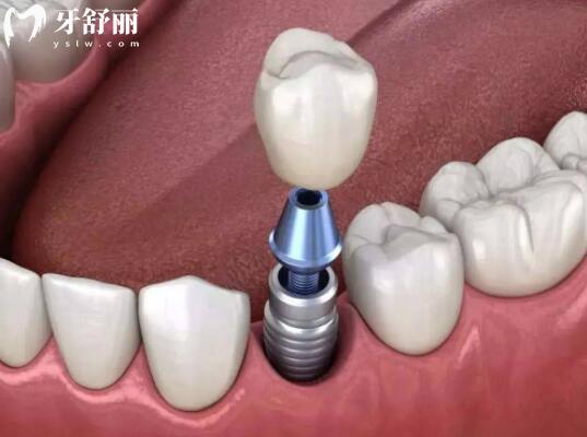 ?？谘揽漆t(yī)院收費標準翻新,拔智齒350+種植牙2600+矯正5800+