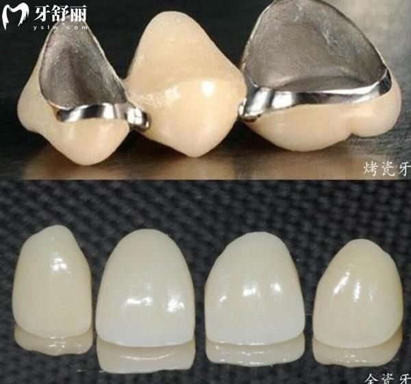海口牙科醫(yī)院收費標準翻新,拔智齒350+種植牙2600+矯正5800+