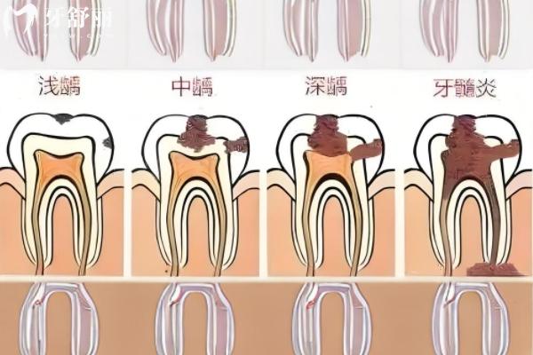 蛀牙不疼也要補是過度醫(yī)療嗎？