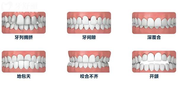 2025北京牙元素口腔收費標(biāo)準(zhǔn)是多少?美國ET種植牙1580+非自鎖矯正9800+全瓷牙1280+