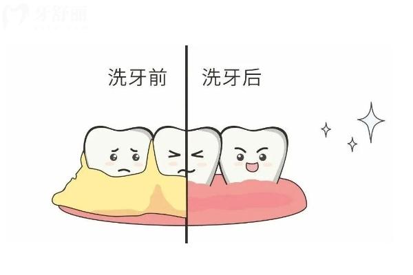 牙齒拋光的作用與注意事項(xiàng)，分享清潔護(hù)齒 + 美觀優(yōu)化的口腔手段