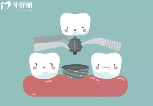 進口種植牙品牌推薦:韓國登騰/瑞士ITI/瑞典諾貝爾/美國皓圣等有質(zhì)保價格不貴