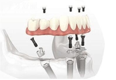廣州暨南雅皓口腔收費(fèi)貴嗎2026收費(fèi)標(biāo)準(zhǔn):韓系種植牙1668(全包)、金屬矯正7188元起、全瓷冠1280元起