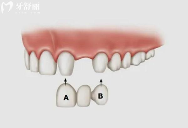 惠州致美口腔2026收費(fèi)標(biāo)準(zhǔn)(二級(jí)醫(yī)院)韓系種植牙2680+