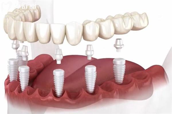 種牙越多越便宜嗎?帶你詳細(xì)了解種植牙價(jià)格高低區(qū)別在哪里?