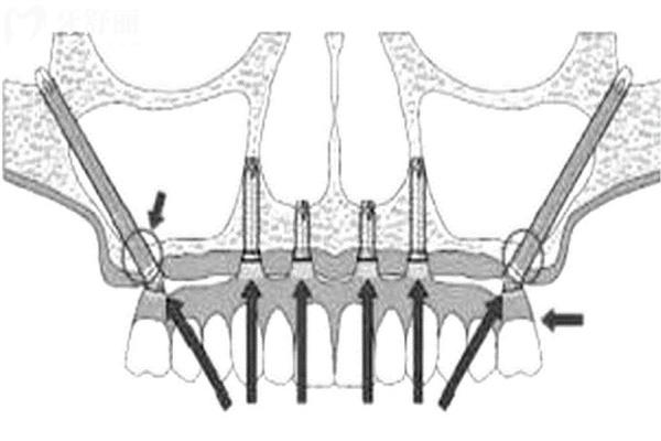 種牙越多越便宜嗎?帶你詳細(xì)了解種植牙價(jià)格高低區(qū)別在哪里?
