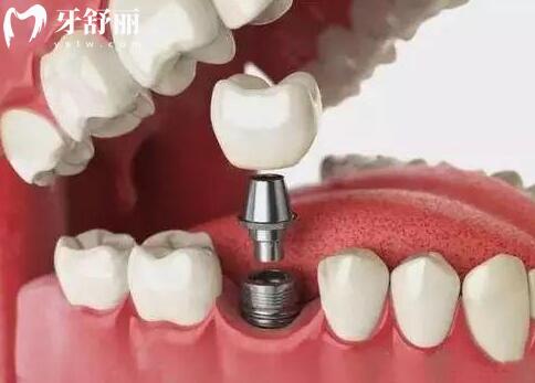 海寧牙博士口腔醫(yī)院收費(fèi)怎么樣高嗎?2026價(jià)格表:韓系種植牙2780+自鎖8700+鑲牙/拔牙也不貴