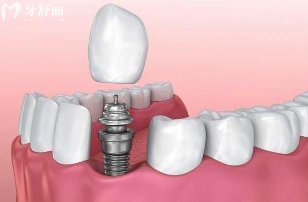寧波種植牙便宜的牙科醫(yī)院排名