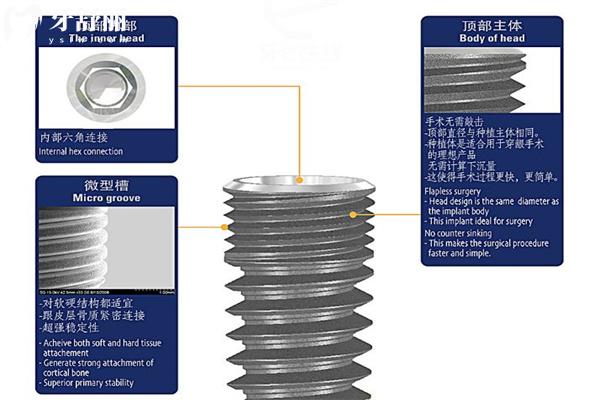 種植牙選國產(chǎn)的還是進口的好?對比種植牙品牌材質(zhì)/使用性能/價格標準等可知