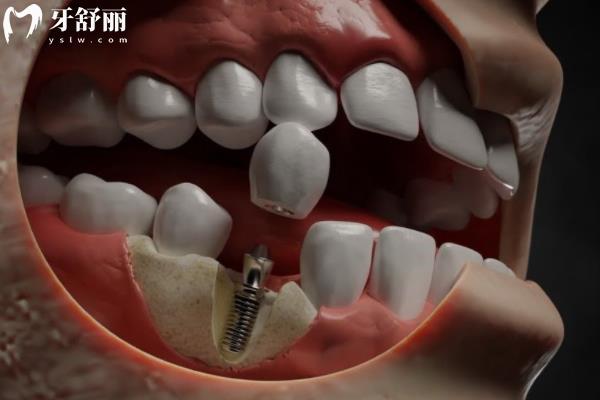 六安悅牙口腔種植牙價格