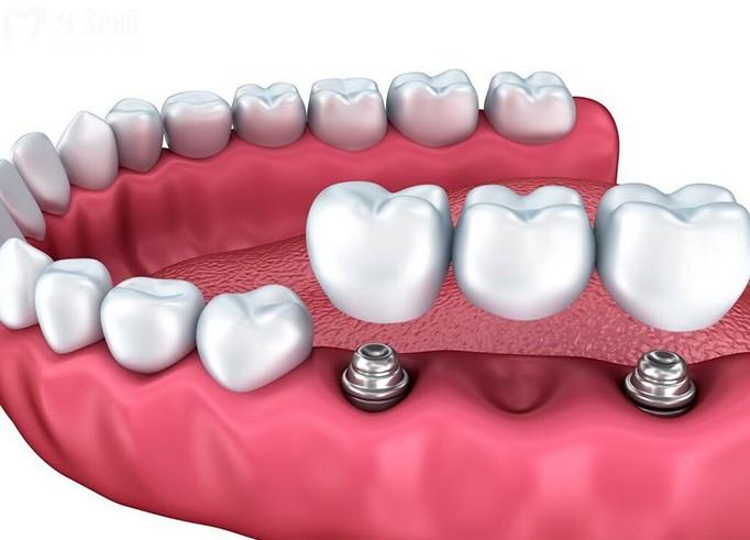 鄂爾多斯種植牙哪個醫(yī)院好?2026口碑好的5家正規(guī)牙科單顆半口全口種牙很不錯