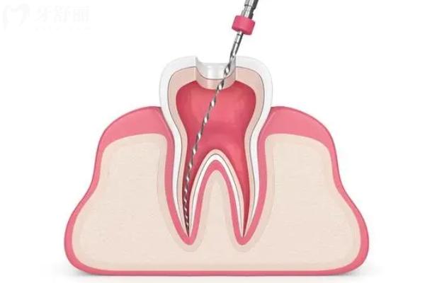 根管治療后戴的牙套能用多久