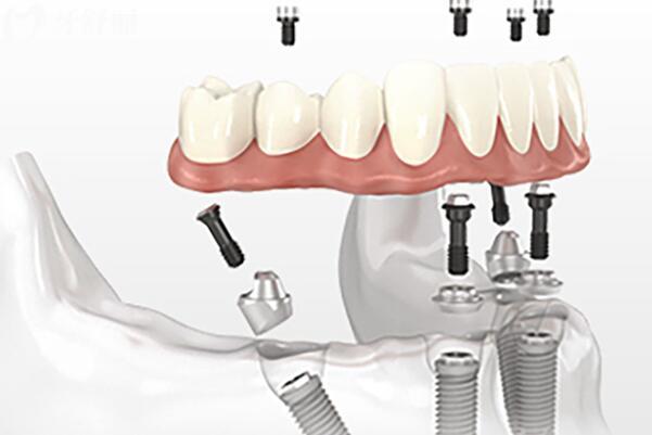 【2026全新調(diào)整】美特爾口腔收費價目表：種植牙、正畸、鑲牙、美白、根管、拔牙等收費都在這