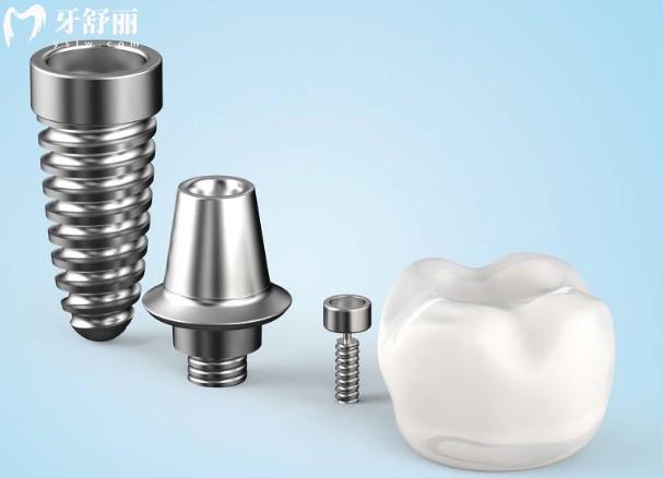 韓國登特斯vs登騰種植牙怎么選？全方面對比材質(zhì)、價格、型號及適用范圍