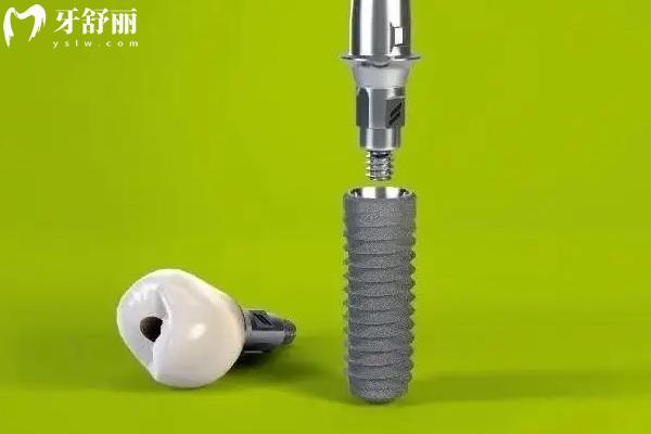 士卓曼種植牙分幾個(gè)檔次