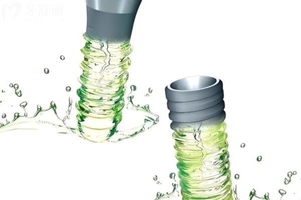 士卓曼種植牙分幾個(gè)檔次