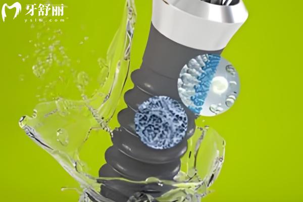 士卓曼種植牙分幾個(gè)檔次