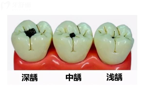 齲齒不處理會一直爛嗎