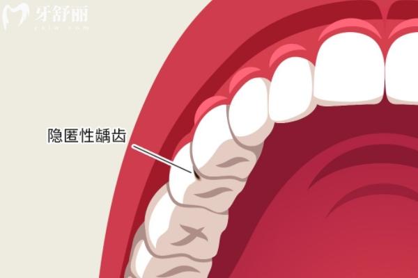 齲齒不處理會一直爛嗎