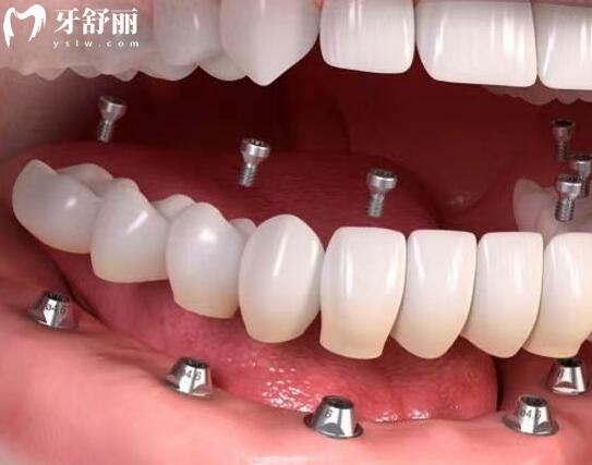 2026云浮口腔醫(yī)院收費(fèi)標(biāo)準(zhǔn):種植牙從國(guó)產(chǎn)1960元起到瑞典諾貝爾8800元起,矯正