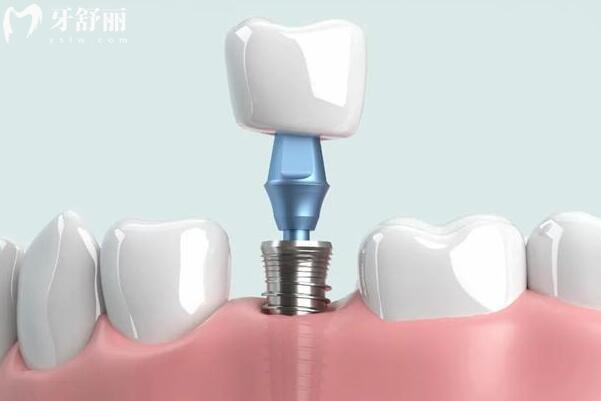 超全江門口腔牙科2026收費標準明細:~種植牙/正畸/牙貼面/補牙/拔牙全涵蓋,價格真實不貴