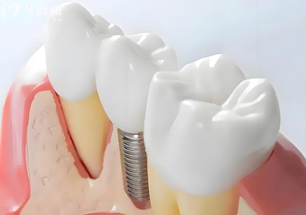 2026蘇州種植牙價格新版出爐:多家正規(guī)口腔種植牙收費不貴