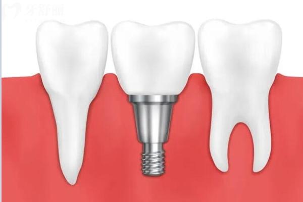 常州佧瓦口腔種植牙怎么樣？資質(zhì) / 價格 / 優(yōu)勢 / 醫(yī)生全攻略