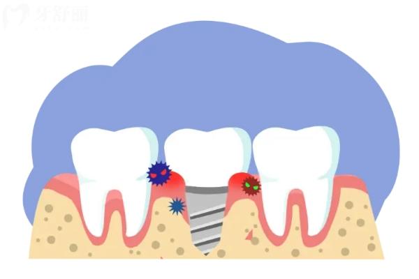 種植牙突然松了怎么辦？緊急處理步驟請收好