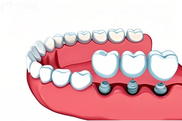 韓國科威爾種植牙怎么樣