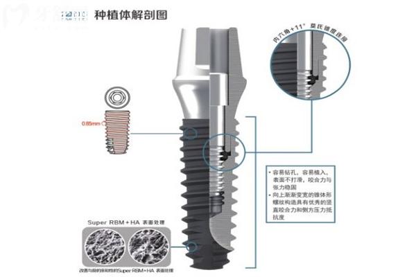 韓國種植體十大品牌排行榜!登騰/奧齒泰/八維/仕諾康等性價比高1500元起