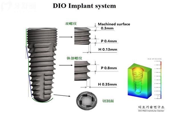 韓國種植體十大品牌排行榜!登騰/奧齒泰/八維/仕諾康等性價比高1500元起