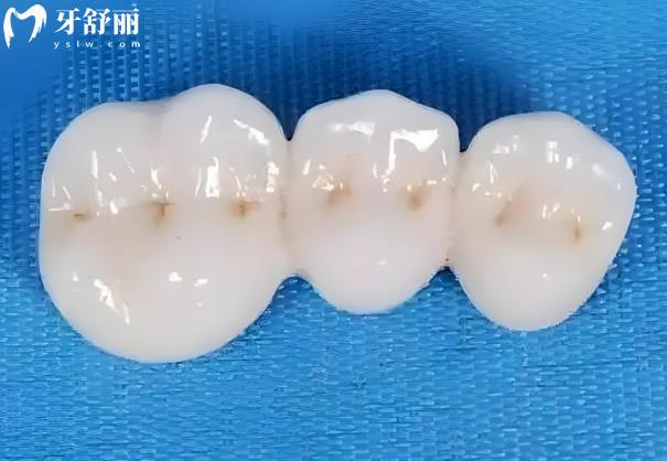 威蘭德牙冠有幾個(gè)檔次?6個(gè)檔次,解析六個(gè)檔次材質(zhì)/使用壽命/價(jià)格