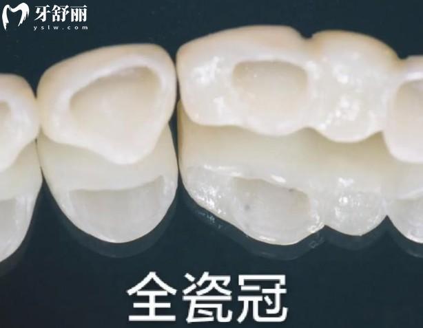 威蘭德牙冠有幾個(gè)檔次?6個(gè)檔次,解析六個(gè)檔次材質(zhì)/使用壽命/價(jià)格