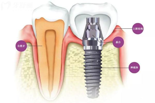 韓國(guó)柯威爾親水種植體價(jià)格不貴