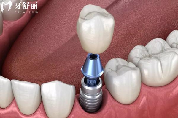 韓國(guó)柯威爾親水種植體價(jià)格不貴