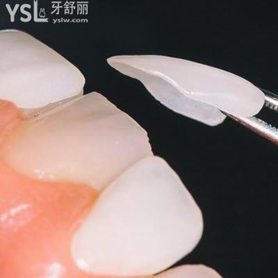 包頭植諾口腔怎么樣？包頭植諾口腔超薄瓷貼面價格貴嗎？