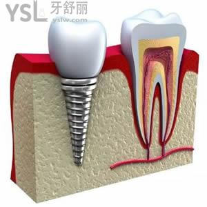 武漢五洲麥芽口腔醫(yī)院韓國奧齒泰種植牙特大優(yōu)惠。