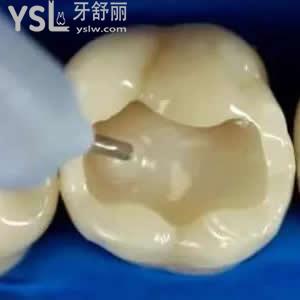 珠海九龍口腔醫(yī)院價格貴嗎？進口3M納米樹脂補牙價格優(yōu)惠。