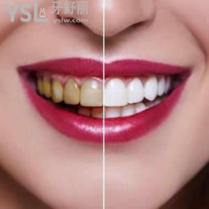 珠海九龍口腔醫(yī)院收費標準，牙齒貼片全瓷貼面優(yōu)惠價格活動。