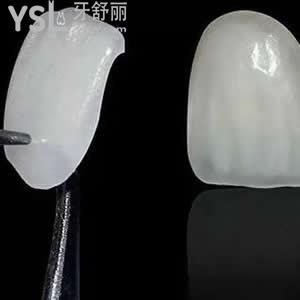 珠海九龍口腔醫(yī)院價目表，牙齒貼片樹脂貼面優(yōu)惠活動