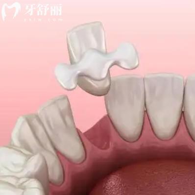 馬里蘭橋和種植牙到底該選啥？一文把優(yōu)缺點(diǎn)都細(xì)細(xì)講清楚