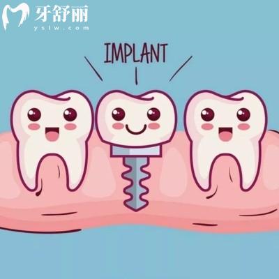全新種植牙十大品牌排行榜及價(jià)格,推薦美國(guó)/德國(guó)/韓國(guó)/瑞士種植體等質(zhì)量好性?xún)r(jià)比高