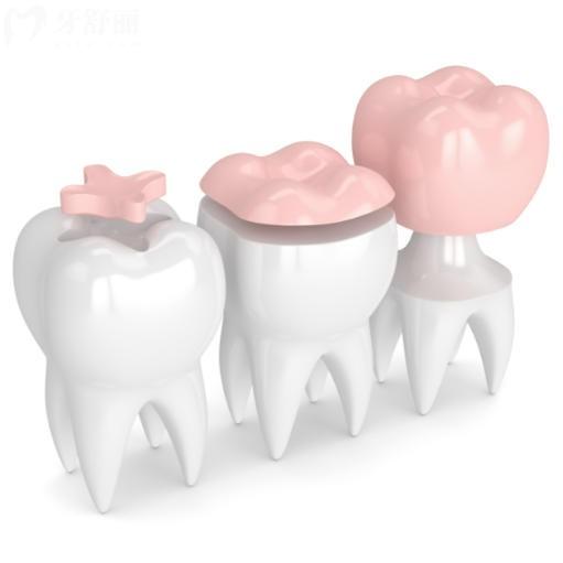 根管治療后戴的牙套能用多久？做好這幾點(diǎn)能用很多年