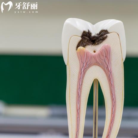 齲齒不處理會一直爛嗎？告訴你真實發(fā)展過程及應對方法