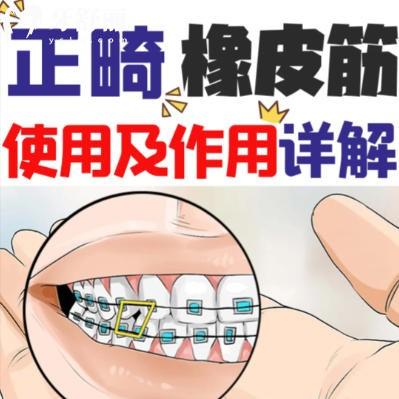 正畸橡皮圈是干嘛用的？詳解矯正皮筋的分類與戴法